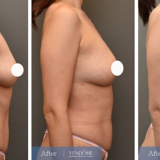 療程效果因人而異，上圖為D罩杯卻乳房下垂的女性在做完自體脂肪隆乳之後​手術後一個月、手術後八個月成效